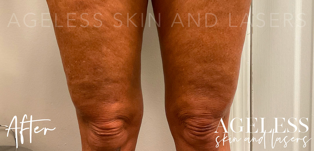 After Image: Skin tightening with hyperdiluted radiesse - front