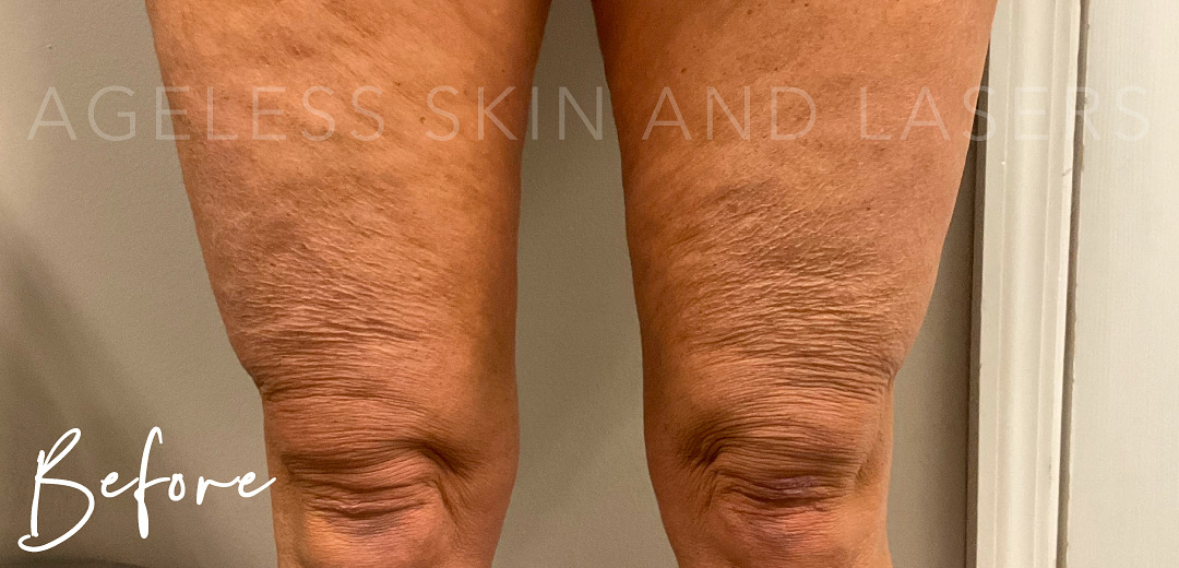 Before Image: Skin tightening with hyperdiluted radiesse - front