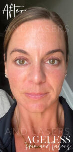 After Image: PRF Undereye