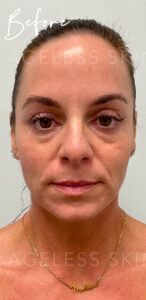 Before Image: PRF Undereye