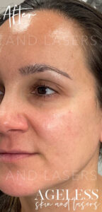 After Image: Microneedling