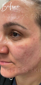 Before Image: Microneedling