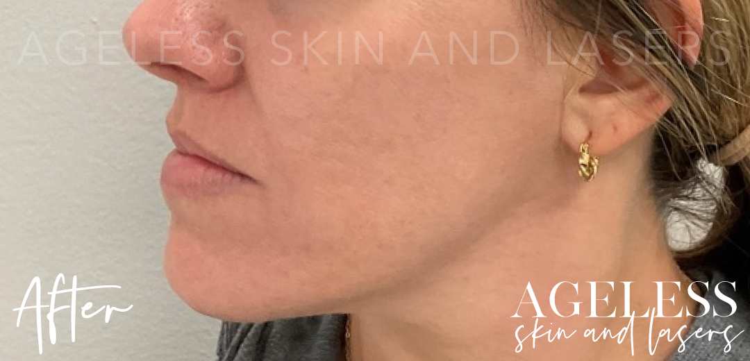 After Image: Microneedling - left-side