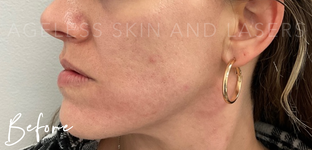 Before Image: Microneedling - left-side