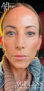 Full facial balancing with dermal filler