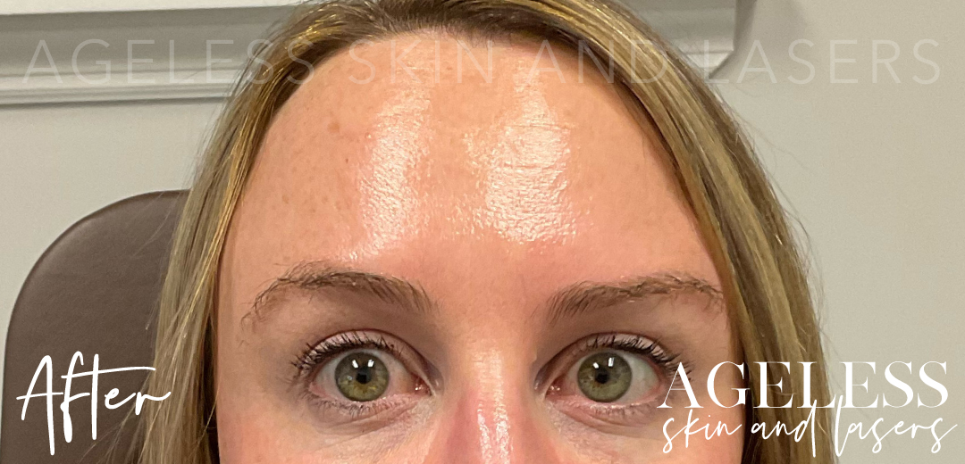 After Image: Botox - front