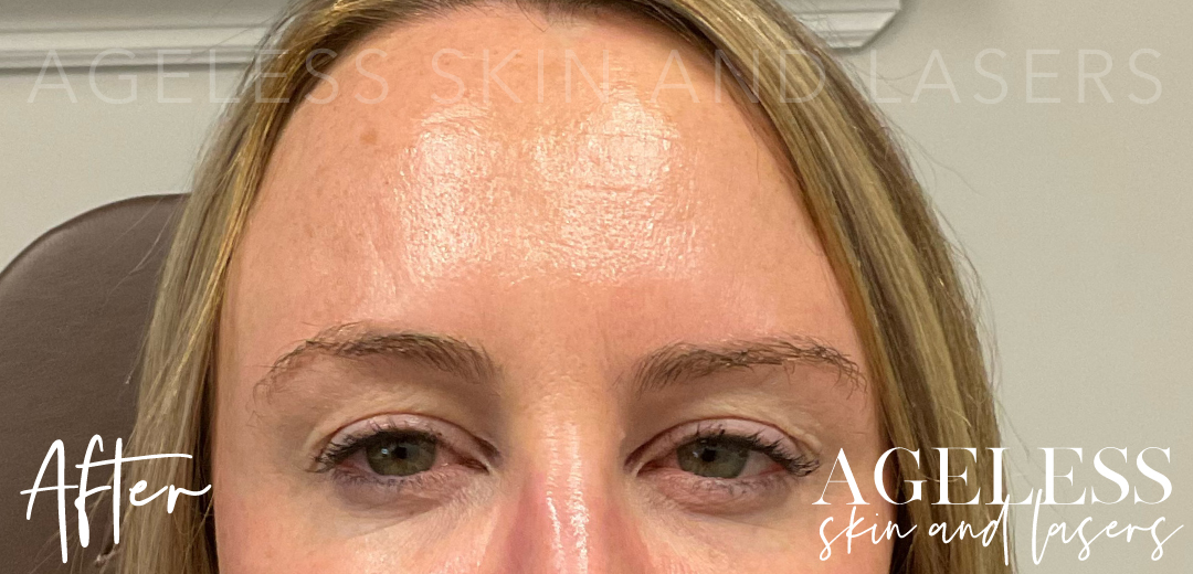 After Image: Botox - front