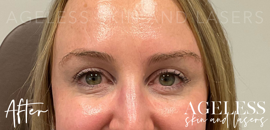 After Image: Botox - front