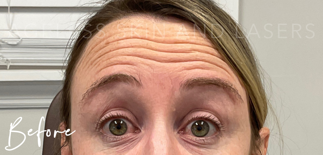 Before Image: Botox - front