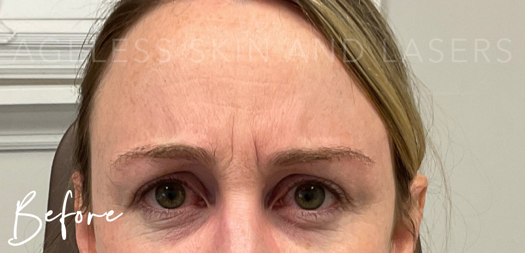 Before Image: Botox - front