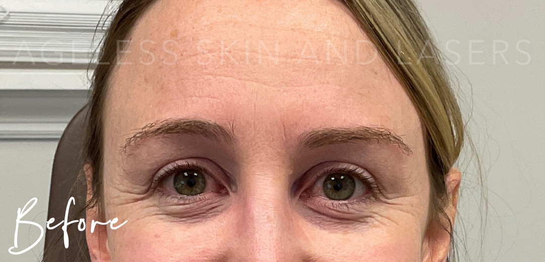 Before Image: Botox - front