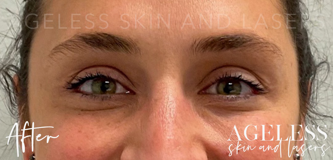 After Image: Botox - front