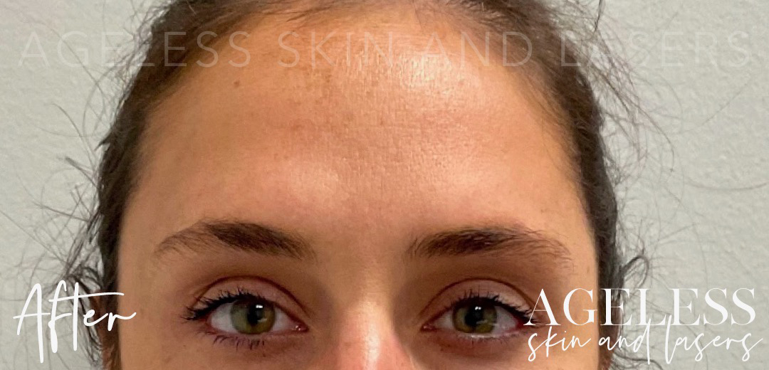 After Image: Botox - front