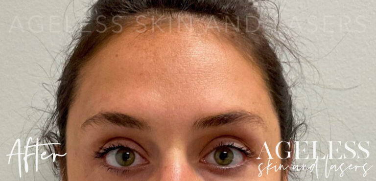 After Image: Botox - front