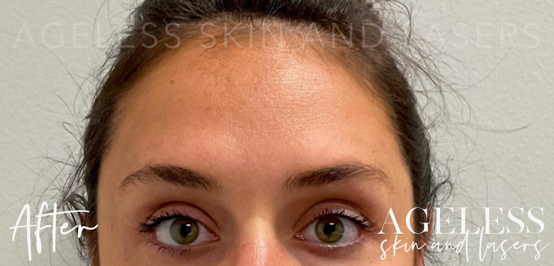After Image: Botox - front