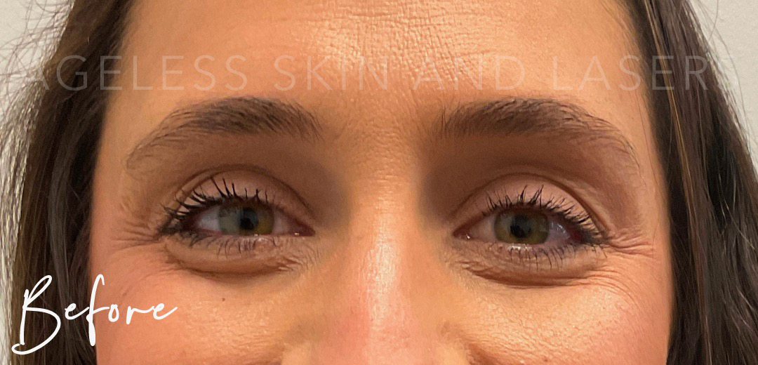 Before Image: Botox - front