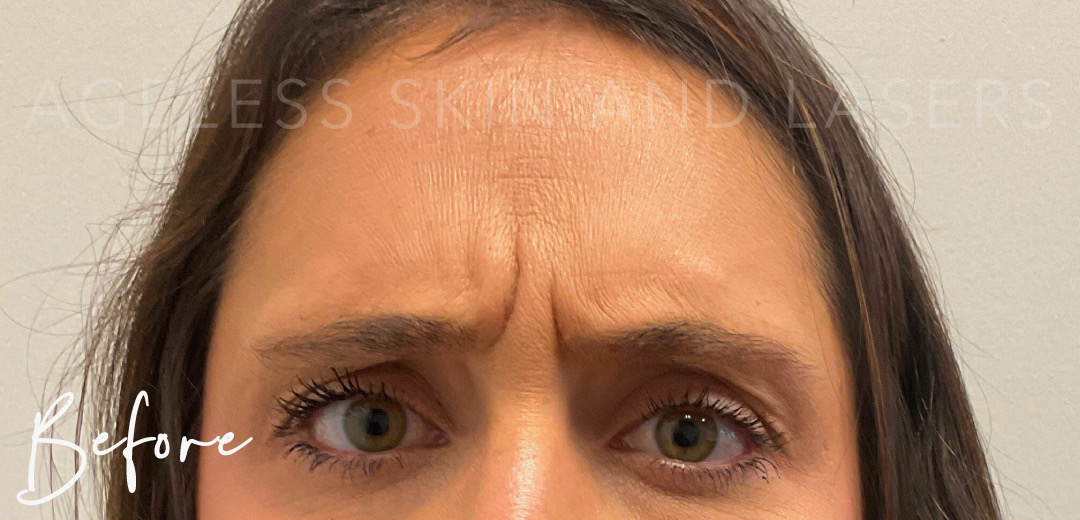 Before Image: Botox - front