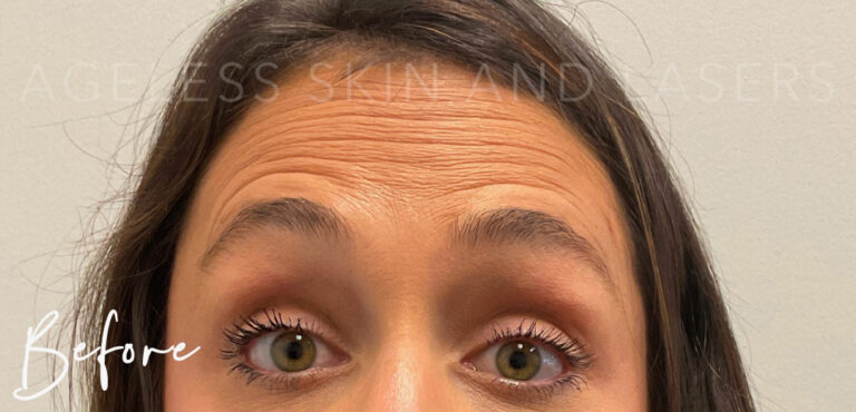 Before Image: Botox - front