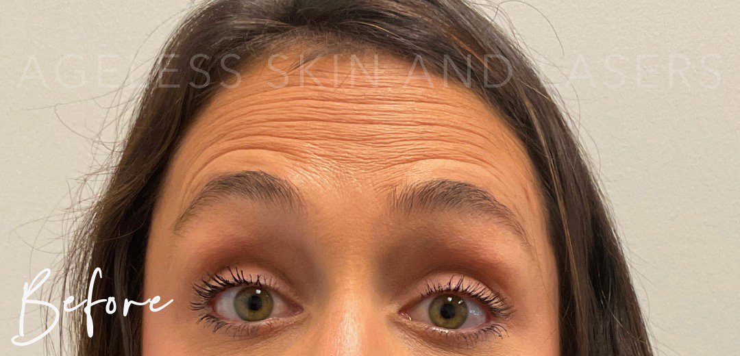 Before Image: Botox - front