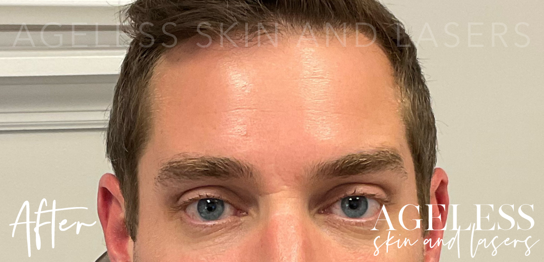 After Image: Botox - front