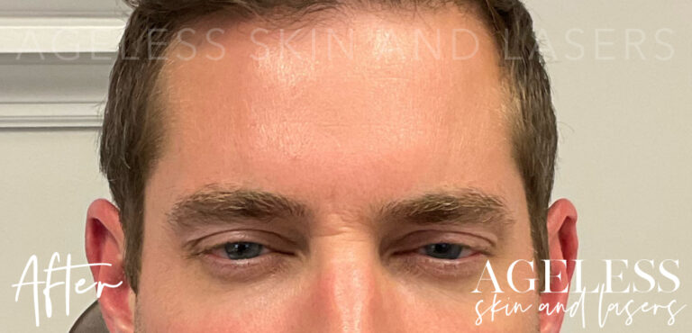 After Image: Botox - front