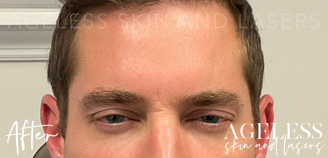 After Image: Botox - front