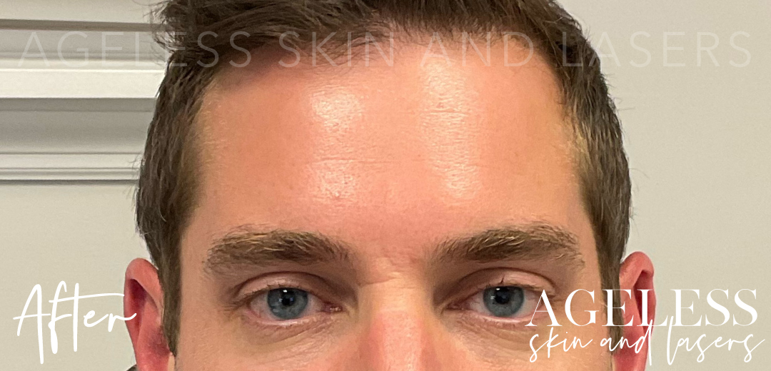 After Image: Botox - front