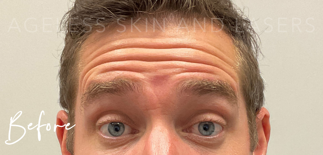 Before Image: Botox - front