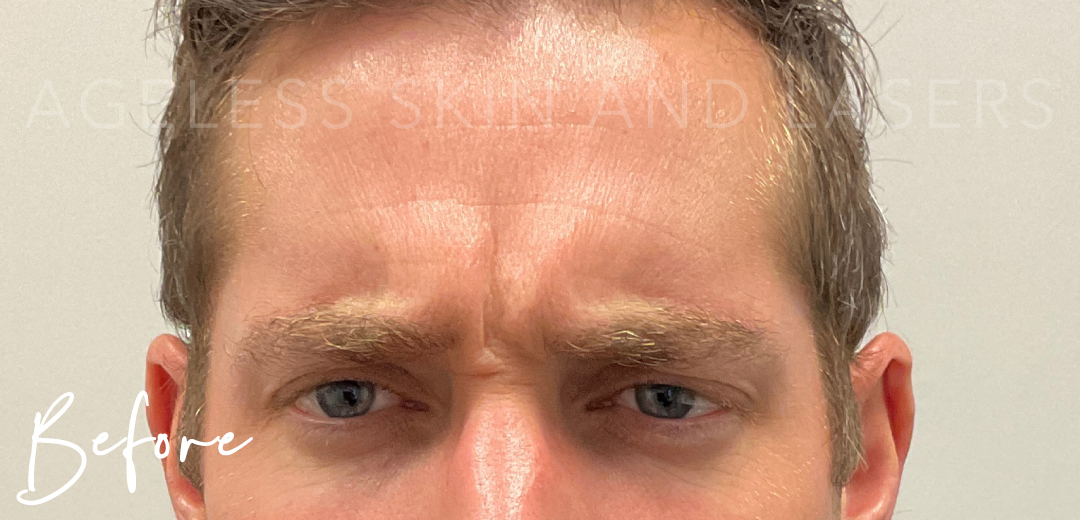 Before Image: Botox - front