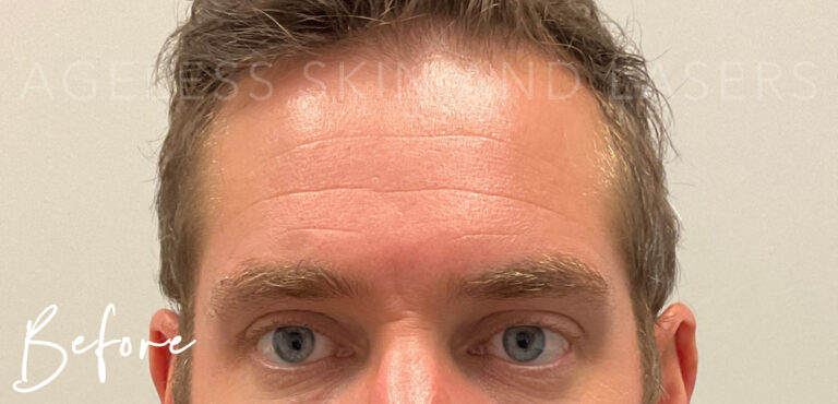 Before Image: Botox - front