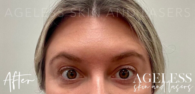 After Image: Botox - front