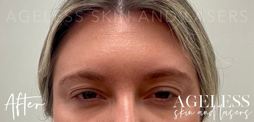 After Image: Botox - front