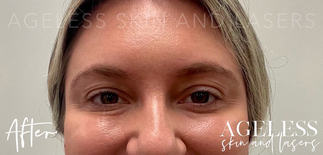 After Image: Botox - front