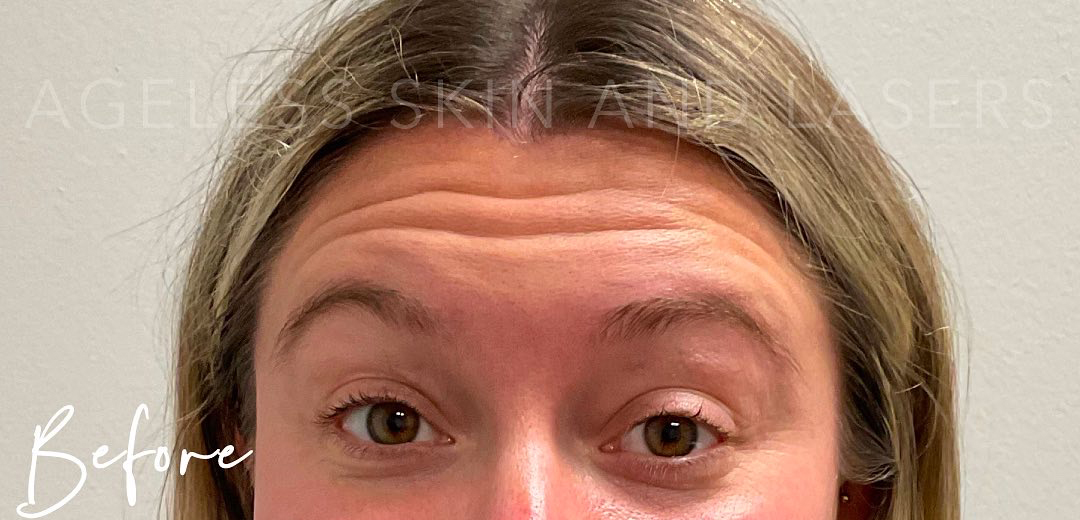 Before Image: Botox - front