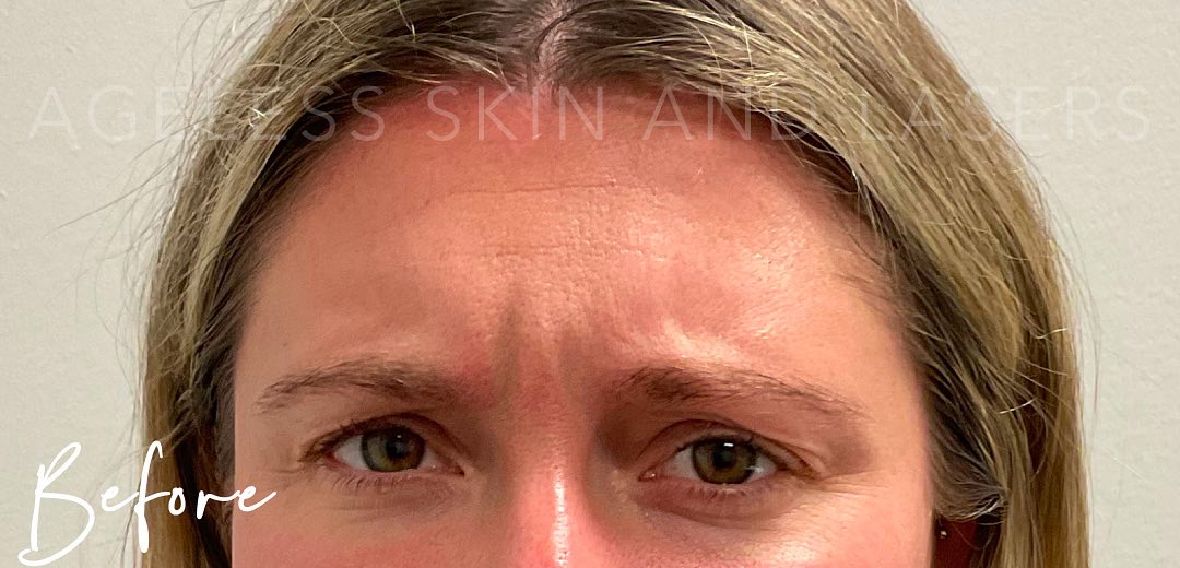 Before Image: Botox - front