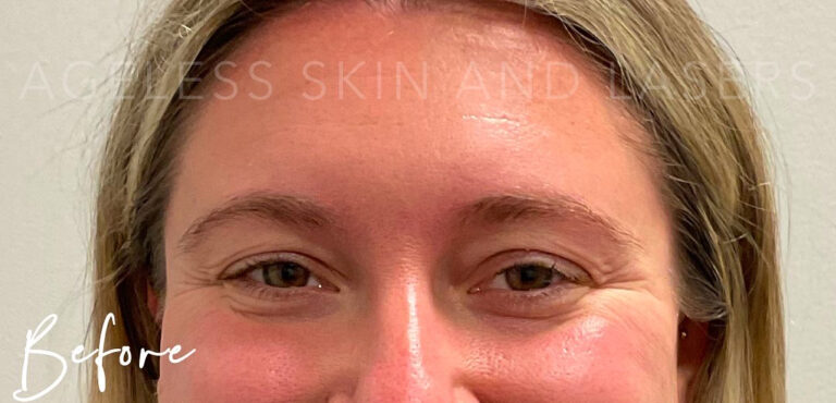 Before Image: Botox - front