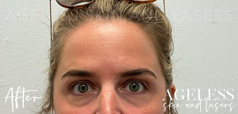 After Image: Botox - front