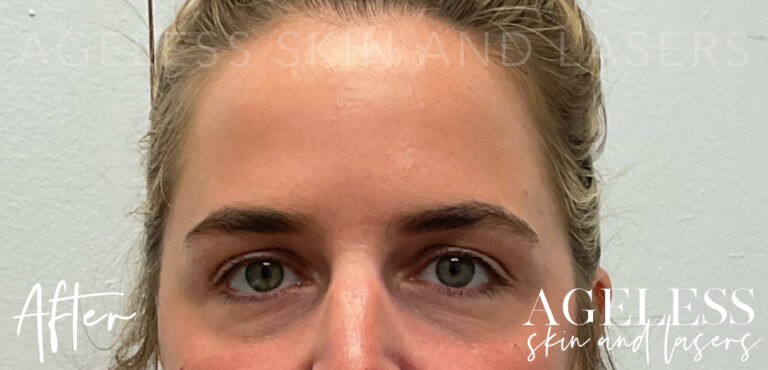 After Image: Botox - front