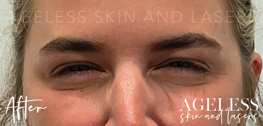 After Image: Botox - front