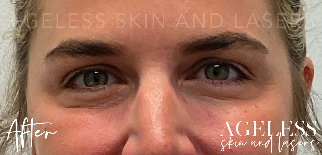 After Image: Botox - front