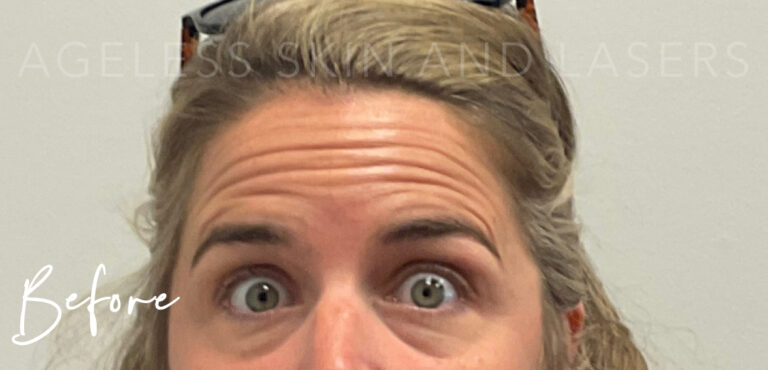 Before Image: Botox - front