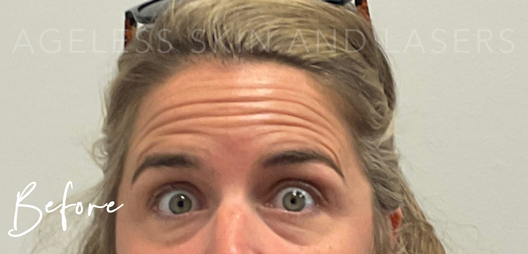 Before Image: Botox - front