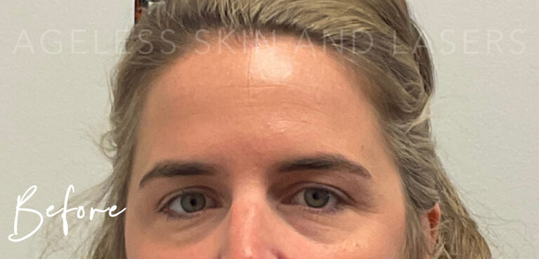 Before Image: Botox - front