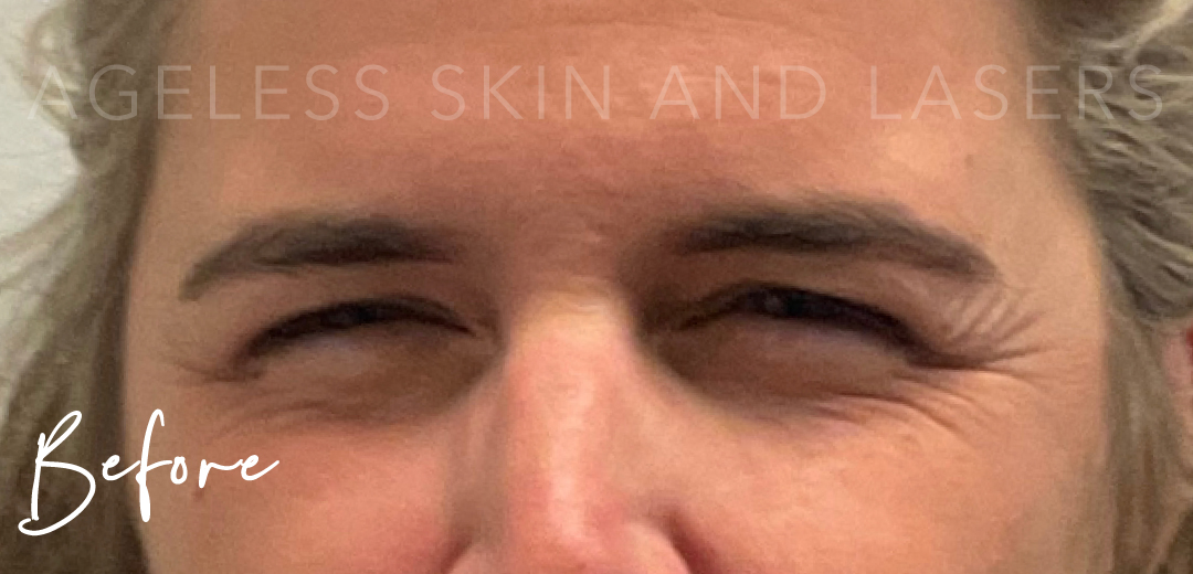 Before Image: Botox - front