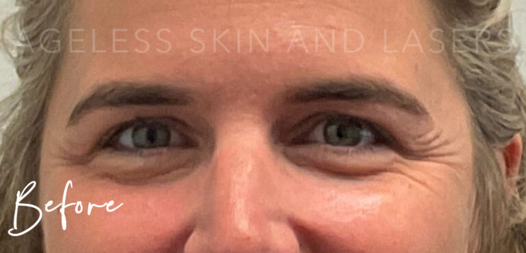 Before Image: Botox - front