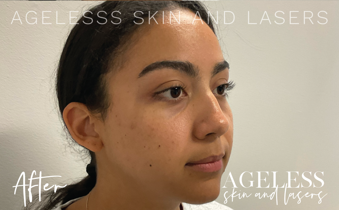 After Image: 3D Miracl Acne Scar Results - right-front-oblique