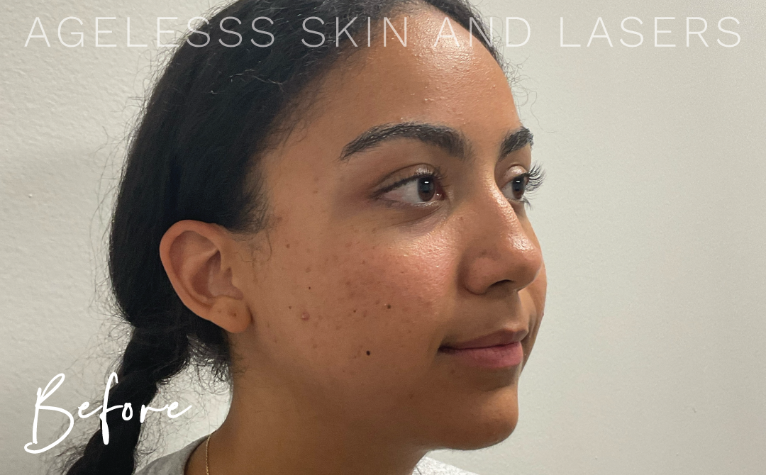 Before Image: 3D Miracl Acne Scar Results - right-front-oblique