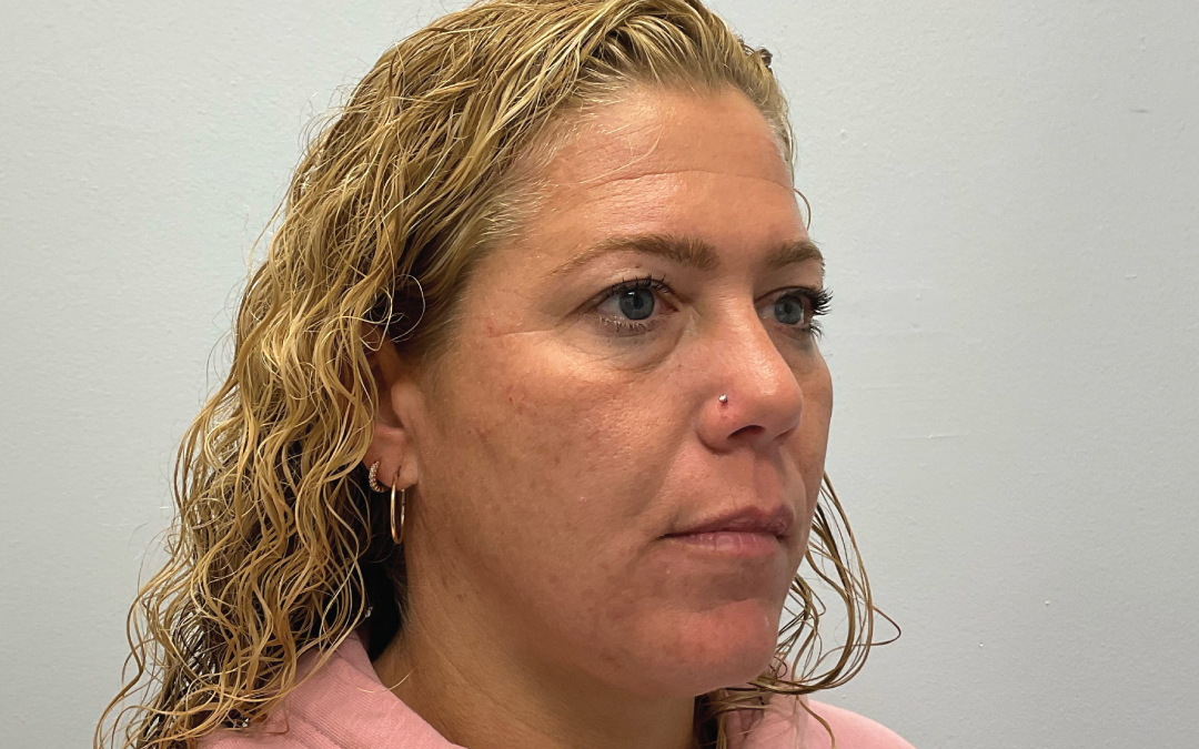 Before Image: 3D Miracl Pigment Results - right-front-oblique