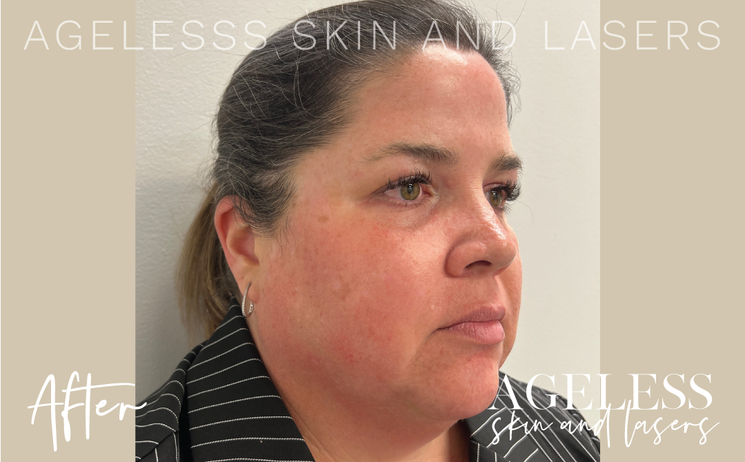 After Image: 3D Miracl Sundamage and Melasma Results - right-front-oblique
