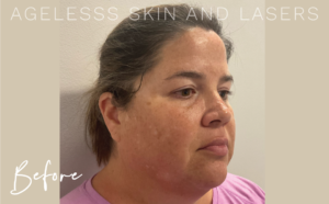 Before Image: 3D Miracl Sundamage and Melasma Results